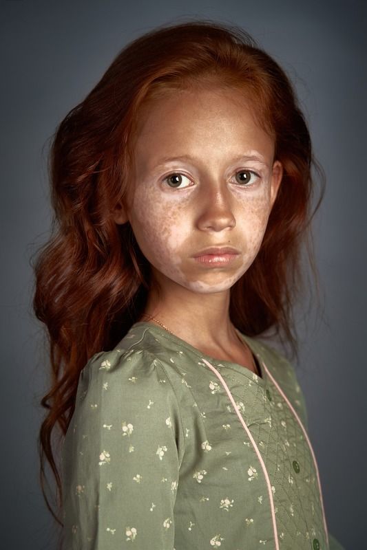 портрет, девочка, дети, витилиго, рыжая, серия, студия, Дианаphoto preview