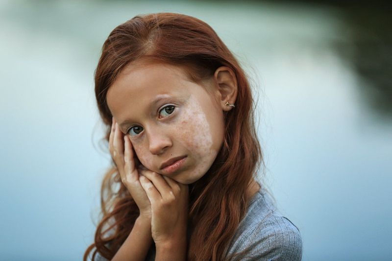 портрет, витилиго, модель, дети Дианаphoto preview