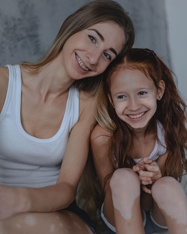 Девочки Витилигоphoto preview